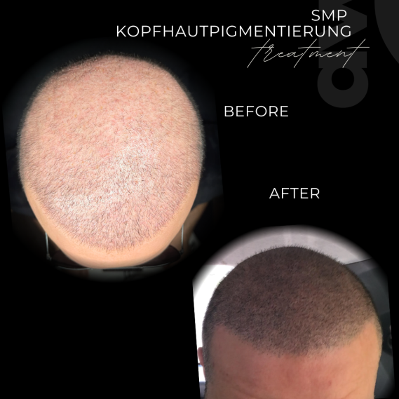 Vorher-Nachher-Vergleich einer Kopfhautpigmentierung SMP. Verbesserter Haaransatz sichtbar.