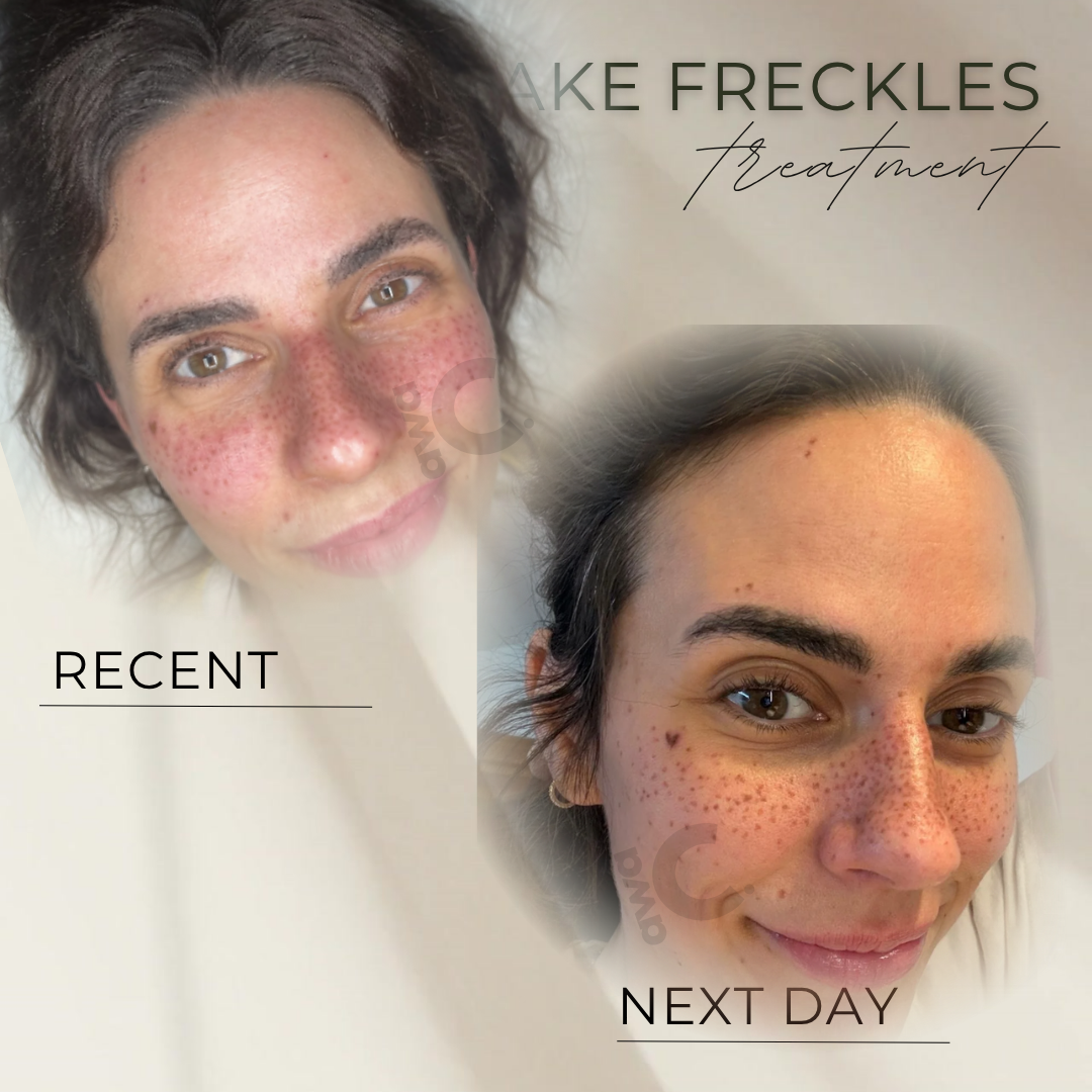 permanente Sommersprossen in Grevenbroich